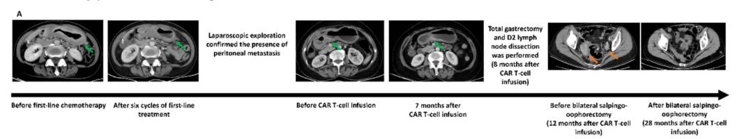 Longitudinal abdominal CT scans showing treatment response from before first-line chemotherapy through 28 months after CAR T-cell infusion, including laparoscopic confirmation of peritoneal metastasis, total gastrectomy with D2 lymphadenectomy, and bilateral salpingo-oophorectomy